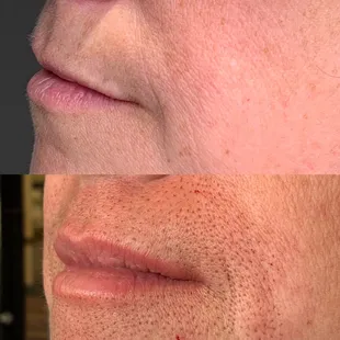 Fibroblast lip flip with Najla