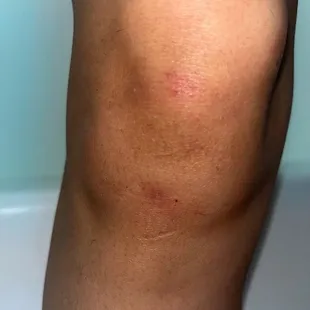 Bruises my friend received on her knee due to the security assaulting her she has more than this