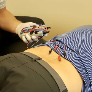dry needling electrical stimulation