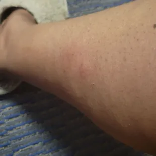 **fingers crossed** ant bites on our legs (please don't be bedbugs)