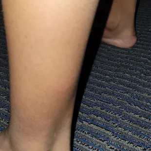 **fingers crossed** ant bites on our legs (please don't be bedbugs)