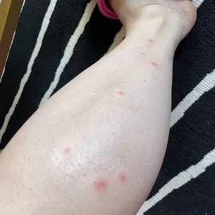 Bite marks from bed bugs