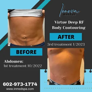 Body sculpting and fat dissolving treatment using Microneedling radio frequency and EvolveX body couture machine.