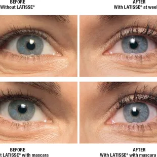 see what Latisse can do for you