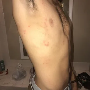 Bed bug bites