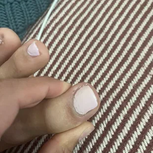 This is a few days after the wound started healing. Look at the polish too...
