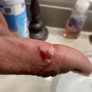 My injuries