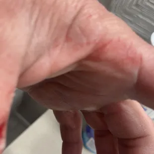 My injuries
