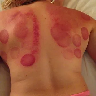 My back after getting cupping treatment. Felt so good! Better than a massage! It released all the tension in my shoulders!!!