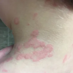 These clusters formed quickly and spread rapidly each day was worse than the last. Increased Each time he ate.