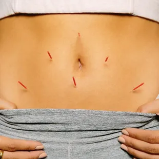 Acupuncture for IBS in Wichita, KS.