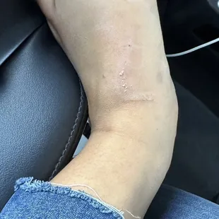 She got hurt and not attended to properly