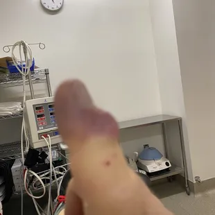Plastic surgery on finger. Damage from PC gaming... never playing another video game again!