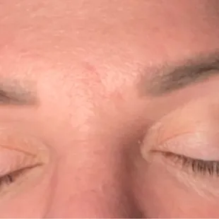 6 days post full set hybrid