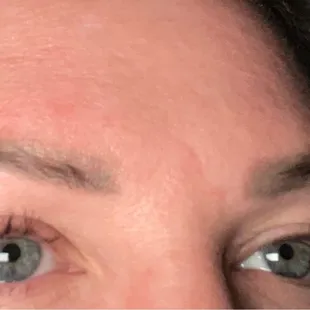 6 days post full set hybrid