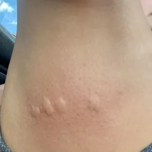 Bites I got from their chair!