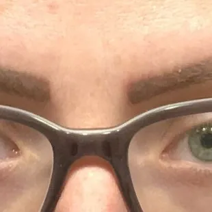 Partially healed brow about 2weeks post treatment