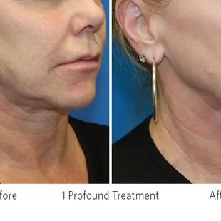 After only One Profound - Non Surgical Treatment