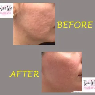 1 session of Sculptra for acne scar improvement