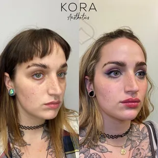 Facial Balancing with dermal fillers! Lifted, polished, refined, and perfectly natural results.