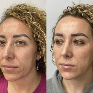 Turning back the clock using dermal fillers and skin care.