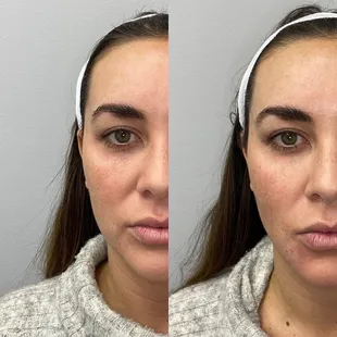 Temple filler and cheek filler to enhance the face shape. Facial balancing and natural results are our specialty.