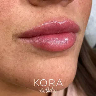 Dermal filler for lips! After two session of lip filler.