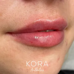 Immediately after her first session of lip filler!
