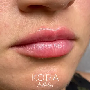 A natural lip enhancement using dermal filler.