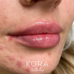 Slow and steady wins the race! Building these lips with dermal filler took two sessions.