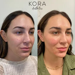 Anti-aging with dermal fillers. Our signature "Facial Balancing" techniques create perfectly natural results.