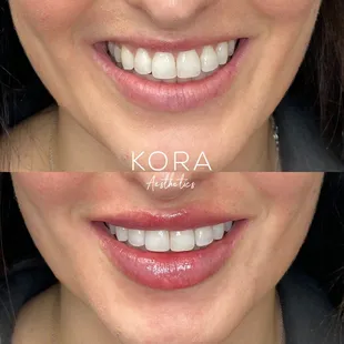 Enhancing smiles with lip filler.