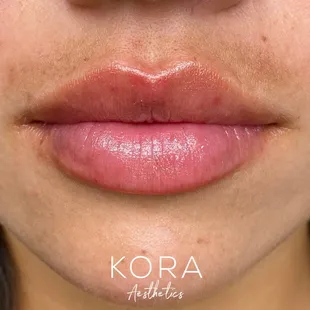 Lip filler results. The natural look is our specialty.