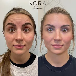 Forehead Botox to treat and erase fine lines and wrinkles. We also love Dysport!