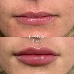 Before and after one lip filler treatment.