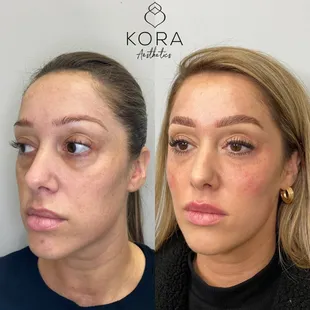 Turning back the clock with our Facial Balancing treatment!