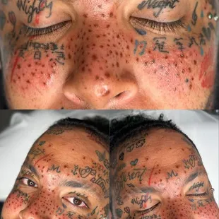 Pmu Freckles - FRESH - immediately after 

Will hear 15-20% lighter