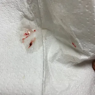 Blood. Blew my nose cause it was running. Smh. Is this normal?