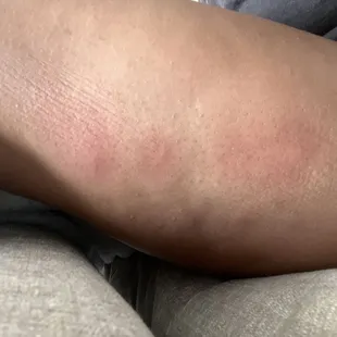 The next day after getting eating by bed bugs!!!