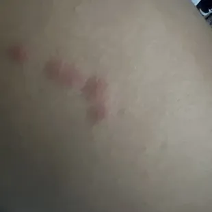 Bed bugs rash