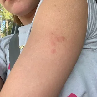 Bed bug bites