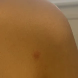 Bed bug bites