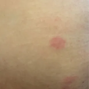 Bed bug bites