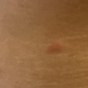 Bed bug bites