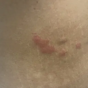 Bed bug bites