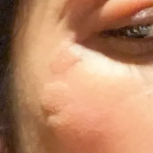 BED BUG BITES ON MY FACE
