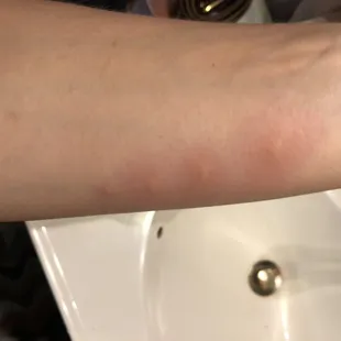 Bed Bug Bites