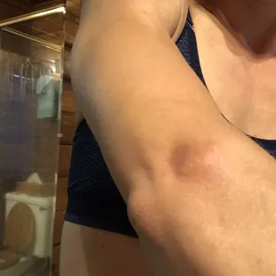 BED BUGS bites