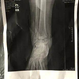 Her ankle was broken in two places.