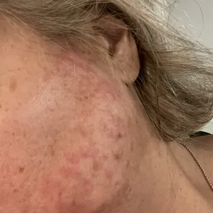 Facial wax results from Julie. I got some burns and a rash.